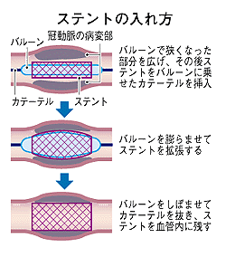 ステント治療.gif