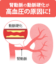 腎動脈硬化症.gif