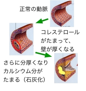 血管石灰化.jpg